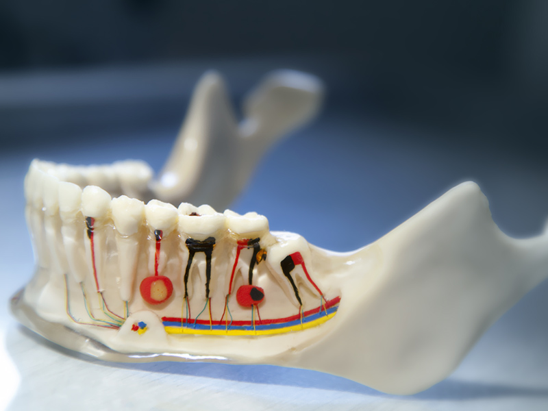 Terapia scanalare e devitalizzazione del dente a Milano da Dental-Luc