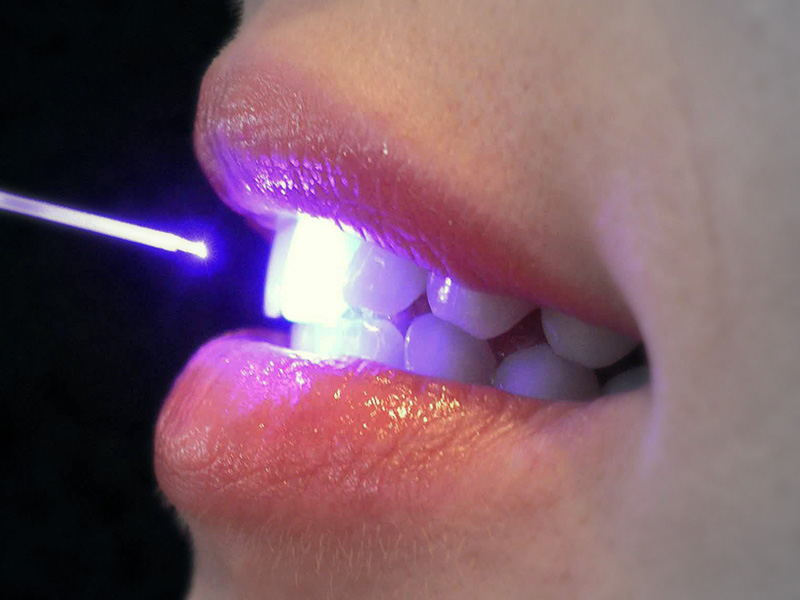Laser per uso medicale e sbiancamento dentale a Milano da Dental-Luc