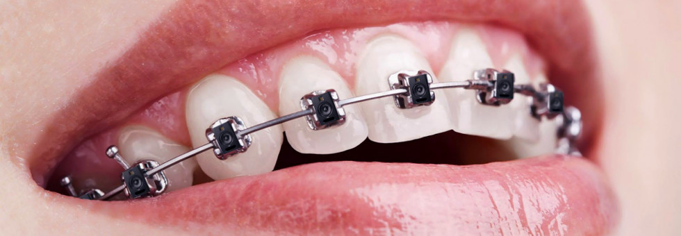 Apparecchio per denti
