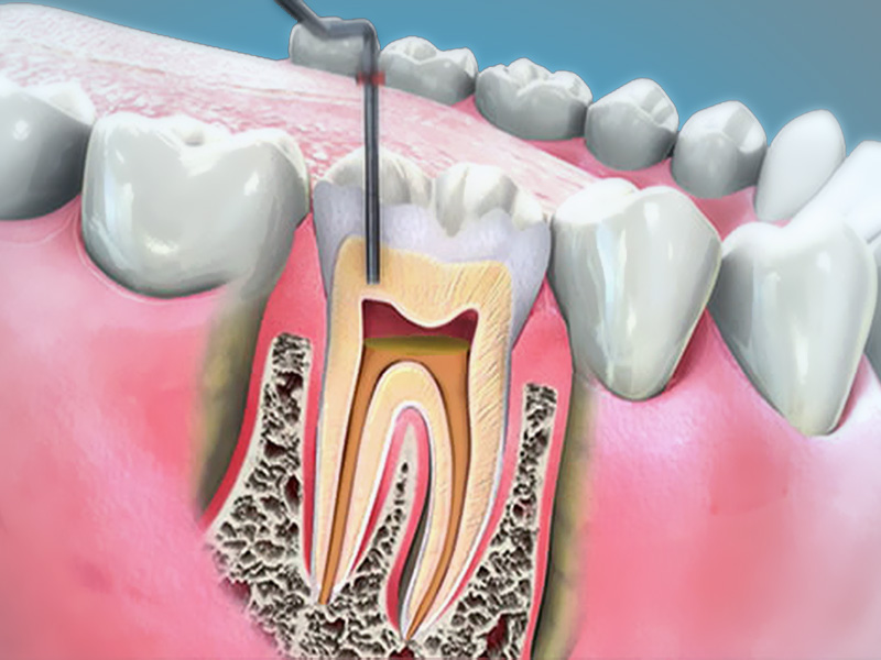 Devitalizzazione dei denti e terapia canalare a Milano da Dental-Luc