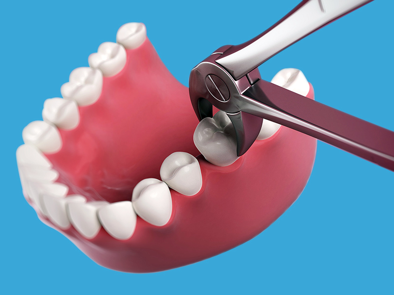 Chirurgia orale ed estrazione dentale a Milano da Dental-Luc