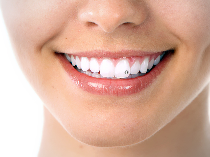 Piercing sul dente e brillantino dentale a Milano da Dental-Luc