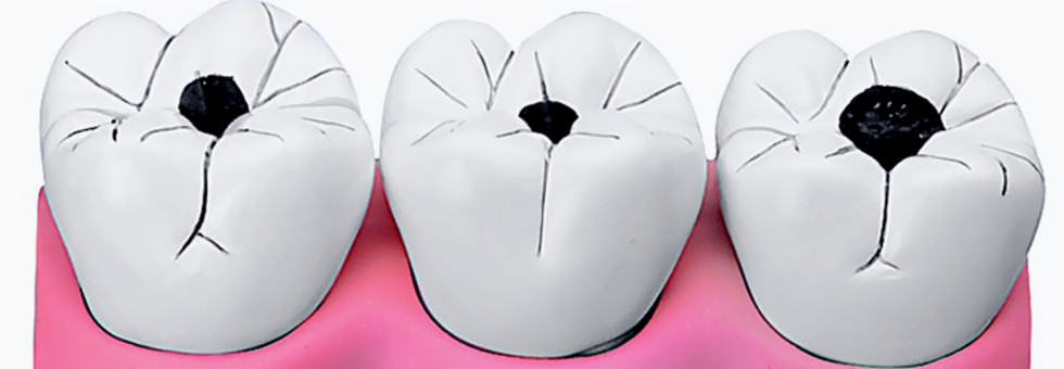 Otturazione dei denti e carie dentale