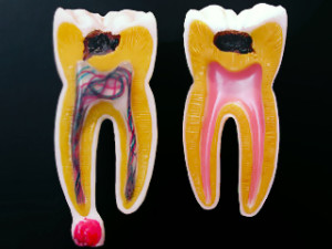 Modellini di denti con carie